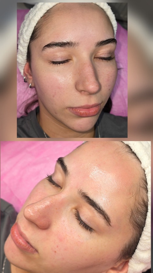 Client LED light therapy before and after at Golden Oasis OL16